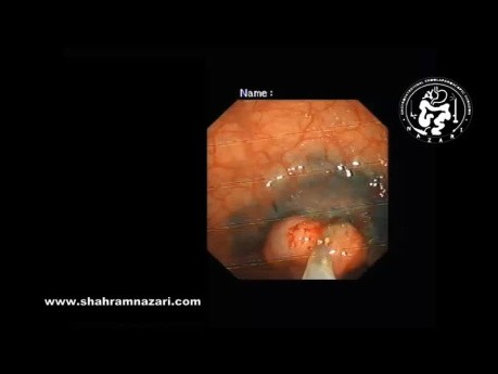 Mucosectomie Endoscopique (EMR) dans la Prise En Charge d'un Gros Polype Rectal