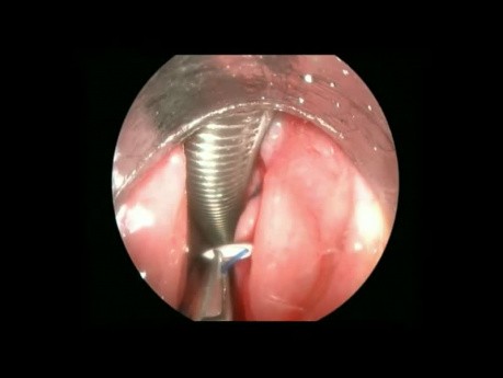 Latéralisation endoscopique des cordes vocales