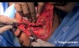 3 repères chirurgicaux pour l'identification du nerf facial pendant la parotidectomie