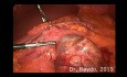 Ablation Laparoscopique des GIST Gastriques