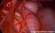 Présentation laparoscopique des défauts diaphragmatiques