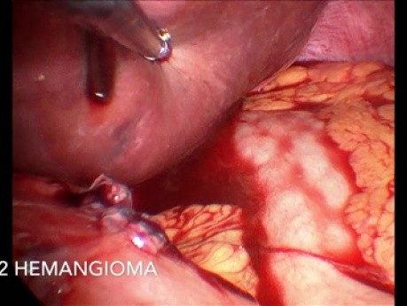 La trisegmentectomie hépatique droite par laparoscopie selon la technique ALPPS.