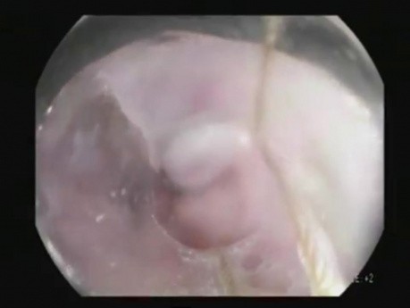 Ligature endoscopique des varices œsophagiennes