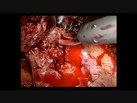 Néphrectomie partielle droite par voie laparoscopique rétropéritonéale