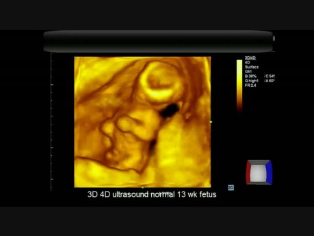 Échographie normale 3D-4D du fœtus de 13 semaines