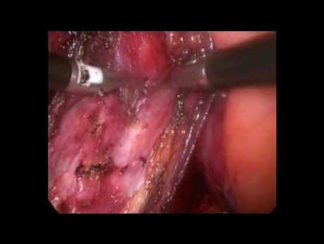 Technique de la dissection chirurgicale de l'espace vésico-utérin et l'espace vésico-vaginal