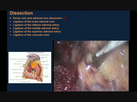 Surrénalectomie gauche laparoscopique en raison d'un grand phéocromocytome - étapes de la chirurgie