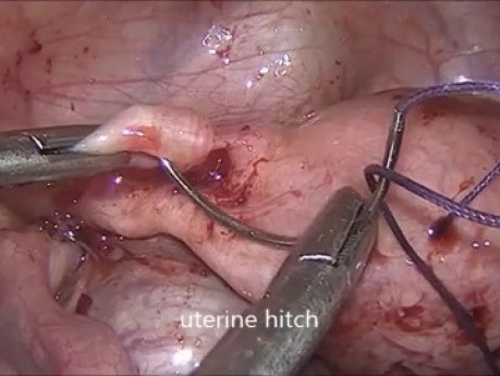Anastomose utéro-vaginale laparoscopique pour l'agénésie cervicale