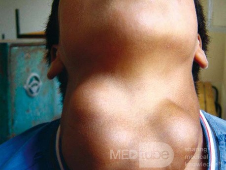 Goitre multinodulaire thyroïdien récurrent