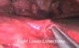 Cancer du Poumon: Lobectomie par Vidéo-Thoracoscopie Uniportale