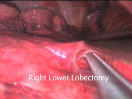 Cancer du Poumon: Lobectomie par Vidéo-Thoracoscopie Uniportale