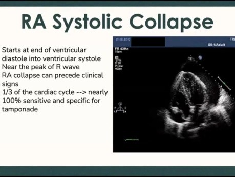 Aperçu de l'Evaluation Echocardiographique des Atteintes Péricardiques