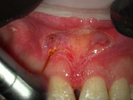 Apectomie Au Laser Erbium Sans Sutures