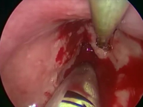 Microlaryngoscopie et Réduction Tumorale