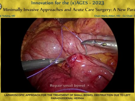 Approche Laparoscopique pour le Traitement de l'Occlusion Intestinale due à une Hernie Paraduodénale Gauche