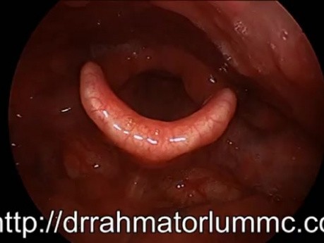 Évaluation des Mouvements Laryngés - Examen Clinique du Larynx