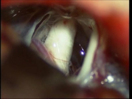 Névralgie du Trijumeau - Décompression Microvasculaire