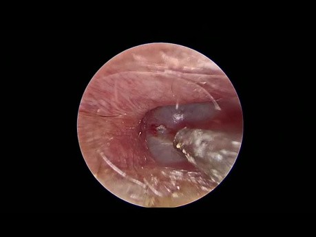 Insertion d'un Tube de Ventilation Endoscopique 