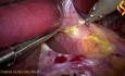 Myotomie de Heller par voie laparoscopique
