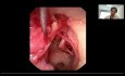 Anatomie Endoscopique de l'Oreille