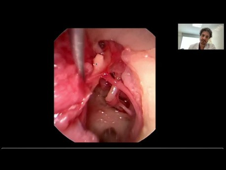 Anatomie Endoscopique de l'Oreille