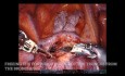 Lobectomie supérieure droite pulmonaire robotisée, non éditée - FACILE