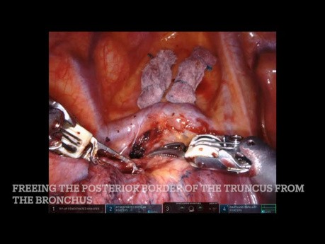 Lobectomie supérieure droite pulmonaire robotisée, non éditée - FACILE