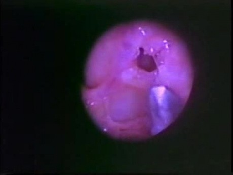 Chirurgie fonctionnelle endoscopique des sinus - Anatomie - partie 5/5