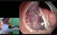 Dissection sous-muqueuse endoscopique (ESD) de - Dr. Makot Nishimura