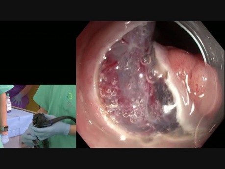 Dissection sous-muqueuse endoscopique (ESD) de - Dr. Makot Nishimura