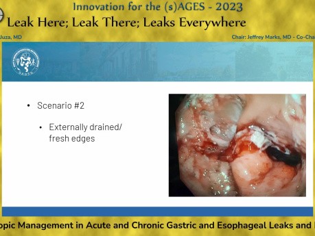 Prise en Charge Endoscopique des Fuites et Fistules Gastriques et Oesophagiennes Aiguës et Chroniques
