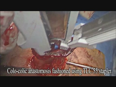 Opération d'inversion de la colostomie en utilisant une agrafeuse automatique circulaire