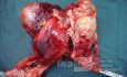Occlusion de l'intestin grêle au cours de l'évolution du lymphome.
