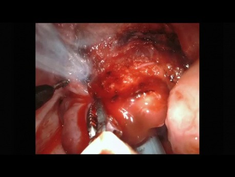 Chirurgie robotique transorale (TORS) Excision d'une base de malformation veinolymphatique de la langue chez un patient pédiatrique