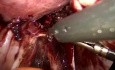 Dissection urétérale