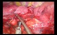 Lobectomie inférieure gauche par chirurgie thoracique vidéo-assistée (CTVA) à l'incision unique sous-xiphoïde
