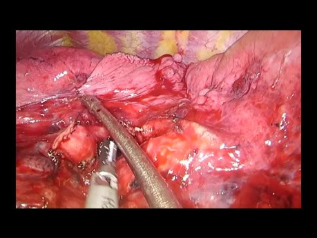 Lobectomie inférieure gauche par chirurgie thoracique vidéo-assistée (CTVA) à l'incision unique sous-xiphoïde