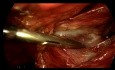 Traitement laparoscopique de la hernie inguinale par voie totalement extrapéritonéale sans utilisation d'électrocoagulation