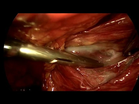 Traitement laparoscopique de la hernie inguinale par voie totalement extrapéritonéale sans utilisation d'électrocoagulation