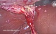 Cholécystectomie Laparoscopique de la Vésicule Biliaire Gauche
