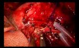 Anastomose vasculaire pendant une double lobectomie par chirurgie thoracique vidéo-assistée (CTVA) à l'incision unique