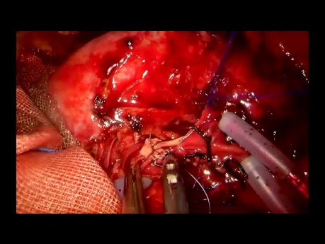 Anastomose vasculaire pendant une double lobectomie par chirurgie thoracique vidéo-assistée (CTVA) à l'incision unique