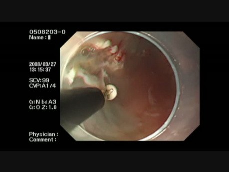 Dissection sous-muqueuse endoscopique (ESD) en raison du cancer de l'œsophage développé à partir du segment long de l'endobrachyœsophage