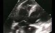 Embolie Pulmonaire avec Thrombus en Transit