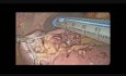 Résection de la tumeur stromale hémorragique de l'intestin grêle par voie laparoscopique
