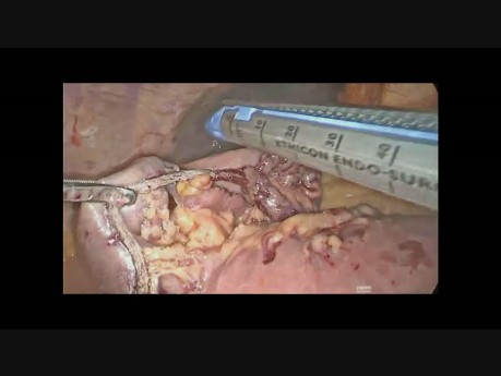 Résection de la tumeur stromale hémorragique de l'intestin grêle par voie laparoscopique