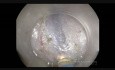 la dissection sous-muqueuse endoscopique (ESD) -pocket creation method