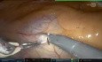 Robotic MVR