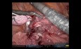 Bi-lobectomie assistée par robot pour une tumeur du lobe supérieur envahissant le lobe moyen