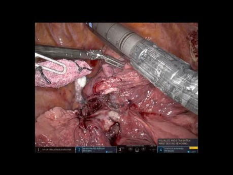 Bi-lobectomie assistée par robot pour une tumeur du lobe supérieur envahissant le lobe moyen